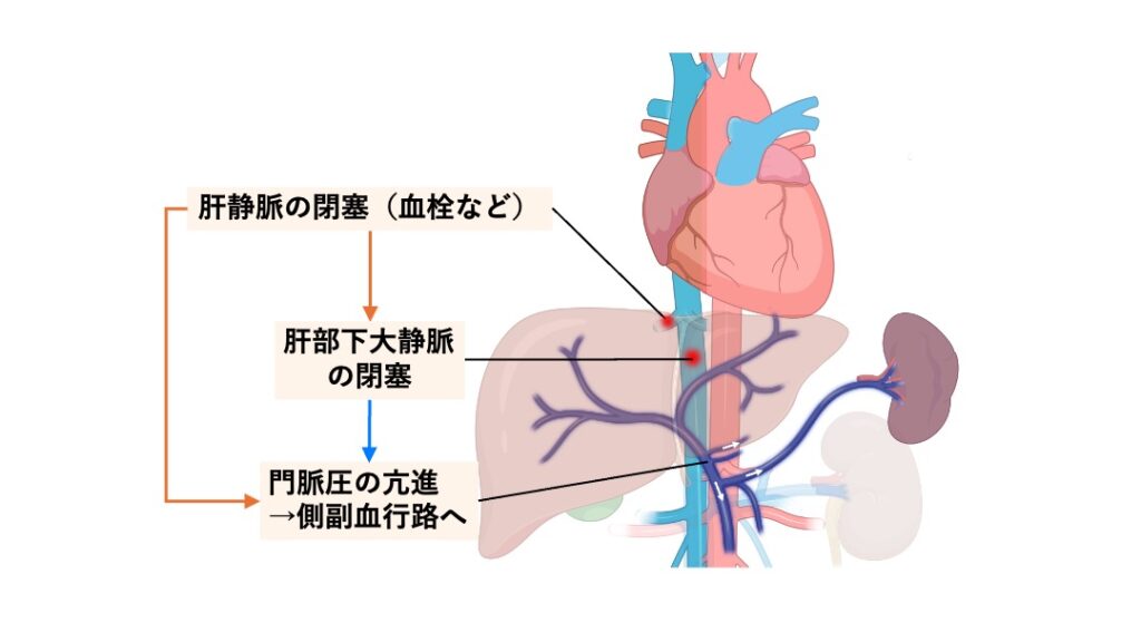 肝静脈や肝部下大静脈の閉塞により、肝臓からの血流が流出できなくなり、
肝うっ血・門脈圧亢進・側副血行路の発達が生じている様子を示す図。