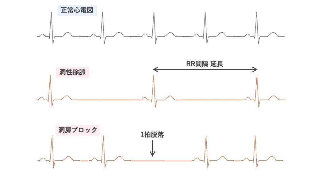 洞不全症候群の心電図。上から順に、正常洞調律、洞性徐脈（RR間隔の延長）、洞房ブロック（1拍脱落）を示す。