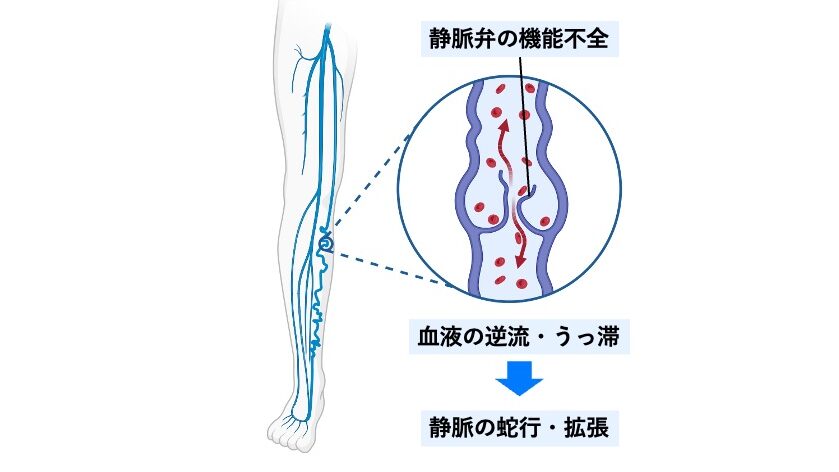 下肢の表在静脈を示した図。静脈弁がうまく閉じず、血液が逆流・うっ滞し、
その結果として表在静脈が拡張・蛇行する過程が描かれている。