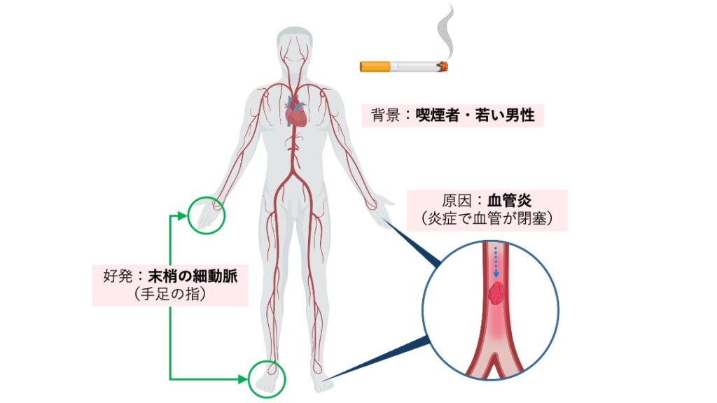 バージャー病の解説図。手指や足趾の末梢細動脈に血管炎が起こり、血栓で閉塞する様子を示している。喫煙が主要因で若年男性に多いこと、炎症により手足の虚血が生じる特徴が視覚的に示されている。