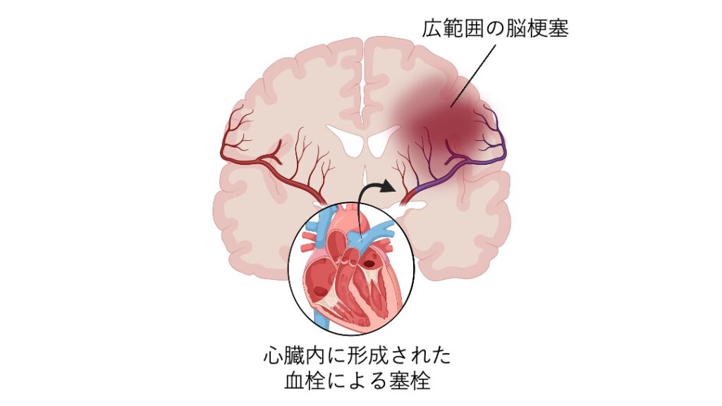 心原性脳塞栓症の発生機序を示した図。
心臓内にできた血栓が血流により脳に運ばれ、脳動脈を閉塞して広範囲の脳梗塞を生じる様子を表している。
脳断面図と心臓の拡大図を用いて、塞栓の経路と影響範囲を示している。