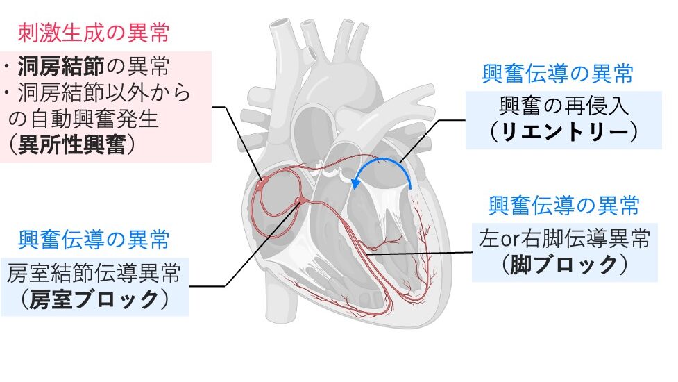 心臓の刺激伝導系と不整脈の発生部位を示した概念図。
不整脈の原因を「刺激生成の異常」と「興奮伝導の異常」に分類している。
刺激生成異常として、洞房結節の異常や洞結節以外からの異所性興奮が示され、
興奮伝導異常として、房室結節伝導異常（房室ブロック）、左右脚の伝導異常（脚ブロック）、
および興奮が同じ経路を再び回る再侵入（リエントリー）が示されている。
赤色は刺激生成異常、青色は興奮伝導異常を表す。