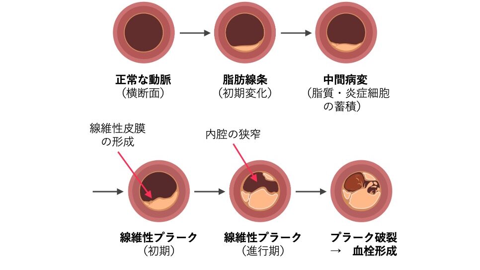 正常な動脈の断面から、脂肪線条、中間病変、線維性プラーク(初期・進行期)、プラーク破裂による血栓形成へと進行するアテローム動脈硬化の段階を示した図。プラークの増大と内腔狭窄の様子が視覚的に示されている。