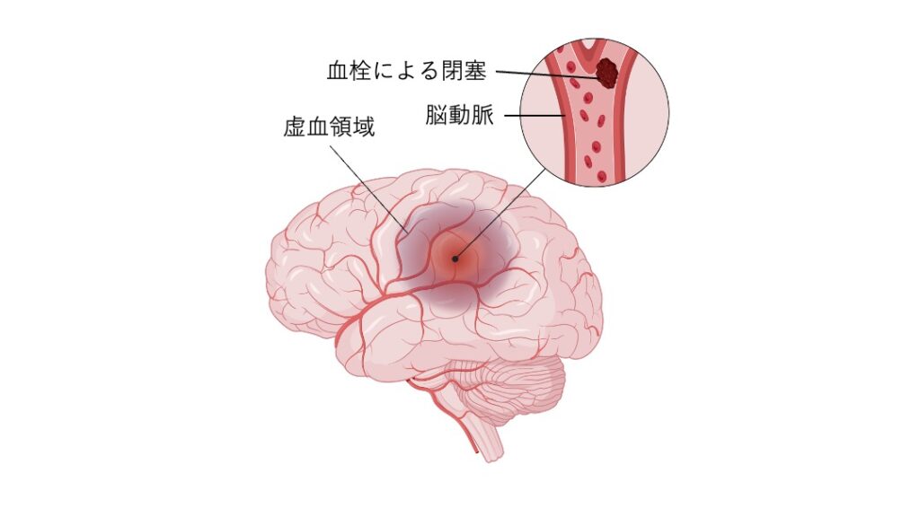 脳梗塞の発生機序を示した図。
脳動脈内に血栓が詰まって血流が途絶え、血管の支配領域に虚血が生じている様子を示す。
脳の断面図と血管拡大図を組み合わせ、閉塞部位と虚血領域の位置関係を視覚的に表している。