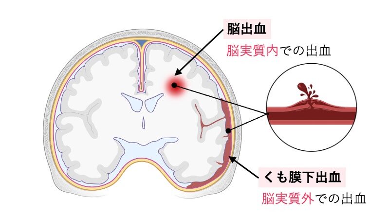 脳出血とくも膜下出血の出血部位の違いを示す脳断面図。
脳出血は脳実質内での出血として赤く示され、
くも膜下出血は脳表面のくも膜下腔に出血が広がる様子として描かれている。
それぞれの出血部位がラベル付きで対比されている。