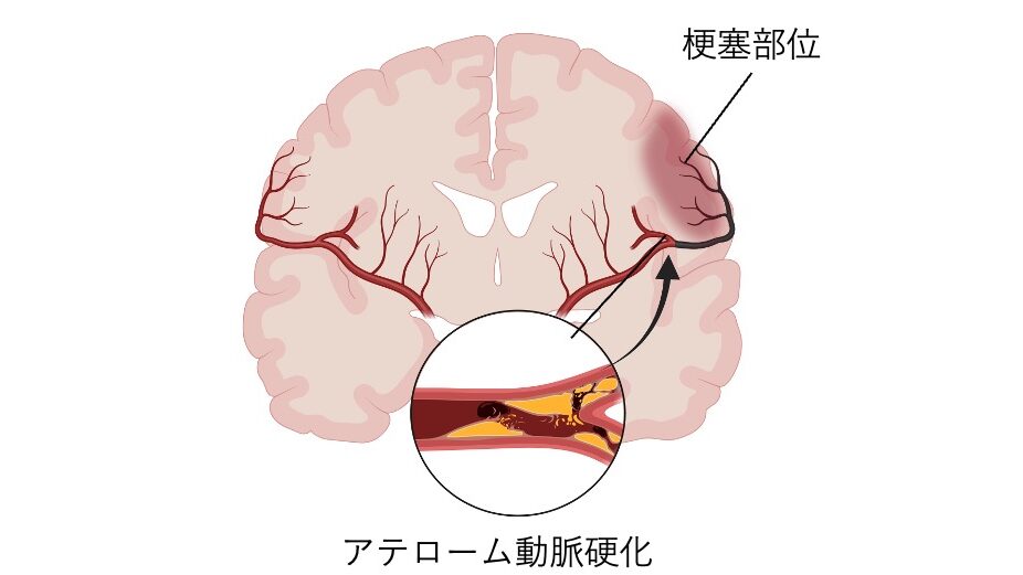アテローム血栓性脳梗塞の発生機序を示した図。
脳の断面図において、動脈硬化による粥状変化と血栓形成が示され、閉塞部位の支配領域に虚血が広がる様子を表している。