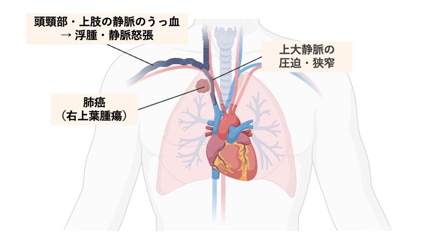 右上葉の肺腫瘍が上大静脈を圧迫し、狭窄が生じている様子を示した図。
頭頸部や上肢の静脈にうっ血が起こり、浮腫や静脈怒張が発生することを示している。
心臓・肺・上大静脈の位置関係と、病態の流れが描かれている。