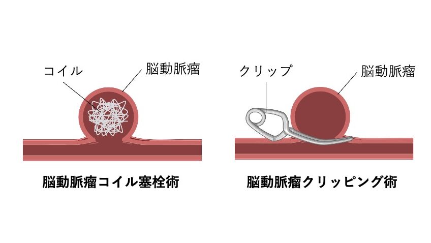 脳動脈瘤の2つの治療法を示す図。
左にコイル塞栓術、右にクリッピング術を描く。
コイル塞栓術では動脈瘤内に金属コイルを詰めて血流を遮断し、クリッピング術では動脈瘤の根元をクリップで挟み破裂を防止する様子を示している。