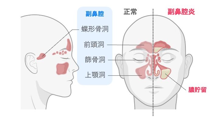 急性副鼻腔炎の模式図。正常な副鼻腔と比較し、上気道感染後に副鼻腔、とくに上顎洞に炎症が生じ、膿が貯留している様子を示している。