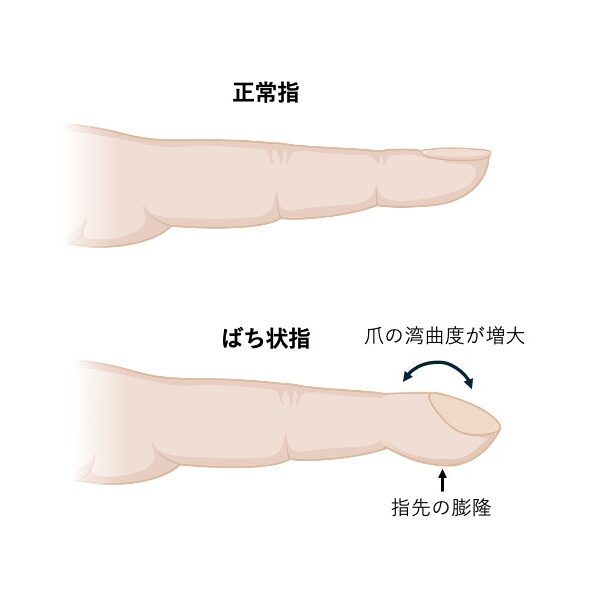 正常な指と、指先が膨らみ爪の湾曲度が増大したばち状指の比較図