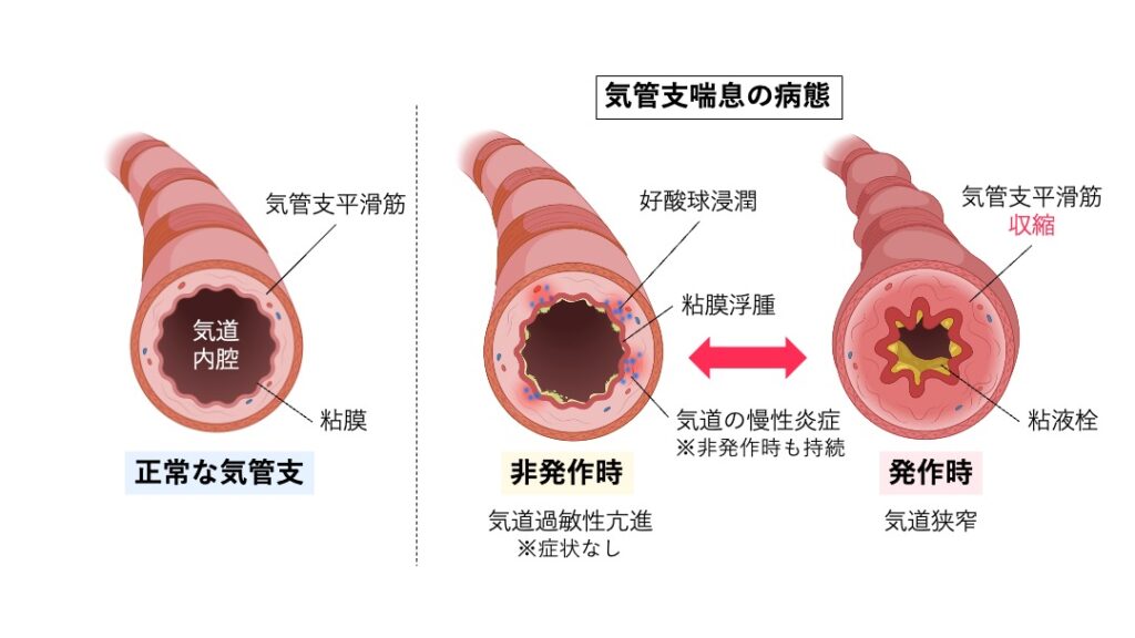 気管支喘息の病態を示した図。左は正常な気管支で、内腔が広く炎症はない。中央は非発作時の喘息で、好酸球浸潤や粘膜浮腫などの慢性炎症がみられるが症状はない。右は発作時で、気管支平滑筋の収縮と粘液栓により気道が著しく狭窄している。