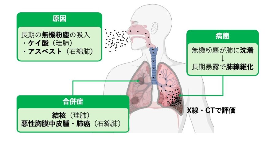 無機粉塵（ケイ酸・アスベスト）を長期吸入することで肺に粉塵が沈着し、肺線維化を起こす塵肺症の病態と、結核や悪性胸膜中皮腫などの合併症を示した図