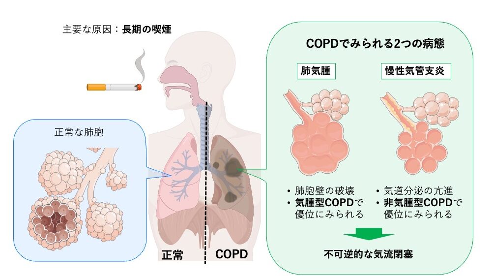 長期の喫煙を背景に発症するCOPDの概念図。正常な肺と比較し、COPDでは肺気腫（肺胞壁の破壊）と慢性気管支炎（気道分泌亢進）がさまざまな割合で混在し、不可逆的な気流閉塞をきたすことを示している。