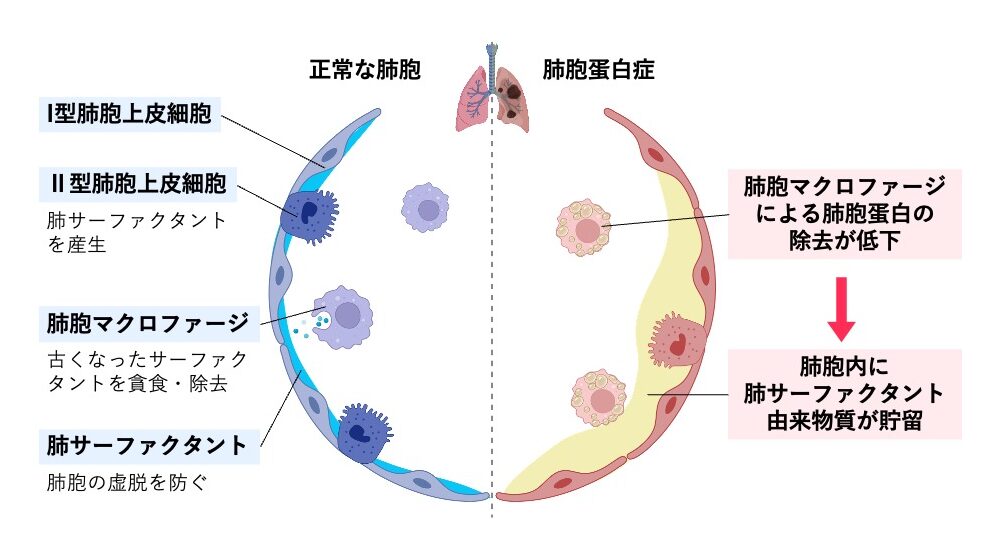 正常な肺胞と肺胞蛋白症の比較図。正常ではⅡ型肺胞上皮細胞が肺サーファクタントを産生し、肺胞マクロファージが除去する。肺胞蛋白症ではマクロファージによる除去が低下し、肺胞内にサーファクタント由来物質が貯留している様子を示す。