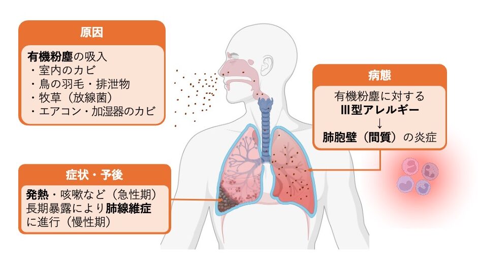 有機粉塵に対するⅢ型アレルギー反応により、肺胞壁（間質）に炎症を起こす過敏性肺臓炎の病態と、急性期症状および慢性化による肺線維化を示した図