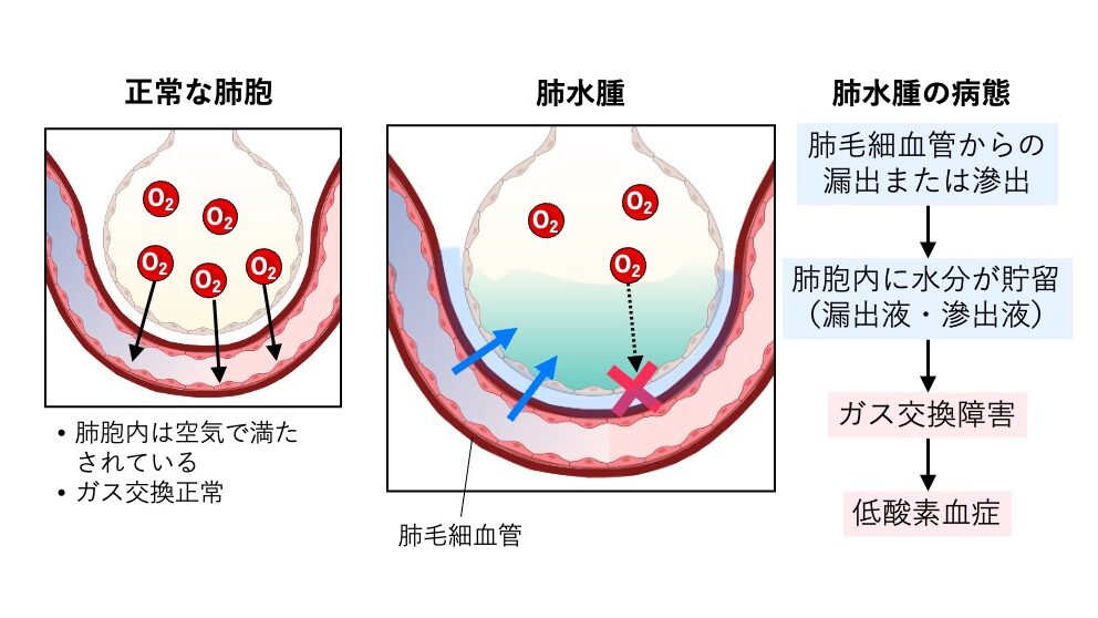 肺水腫の模式図。正常な肺胞では空気で満たされガス交換が行われるが、肺水腫では肺毛細血管から移動した水分が肺胞内に貯留し、ガス交換が障害される様子を示す。