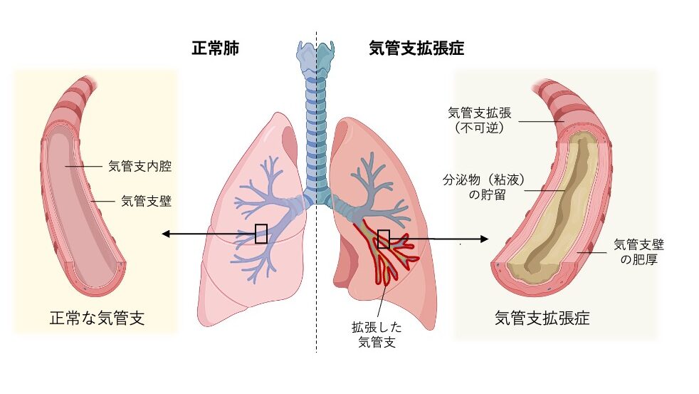 気管支拡張症の病態を示した図。中央に正常肺と気管支拡張症の肺を対比し、左は正常な気管支で内腔が保たれている。右は気管支拡張症で、気管支が不可逆的に拡張し、気管支壁の肥厚と分泌物（粘液）の貯留がみられる。拡張した気管支では気道の自浄作用が低下し、感染を反復しやすいことを示している。