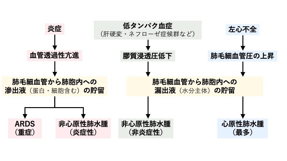 肺水腫の原因分類を示した模式図。炎症による血管透過性亢進、低タンパク血症による膠質浸透圧低下、左心不全による肺毛細血管圧上昇の3つの機序と、それぞれに対応する肺水腫（ARDS、非心原性肺水腫、心原性肺水腫）を示す。