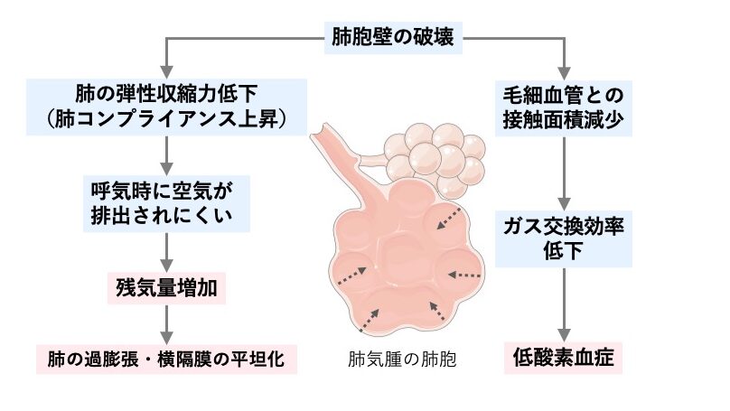 肺気腫における病態生理を示した図。肺胞壁の破壊により肺の弾性収縮力が低下し、呼気時に空気が排出されにくくなることで残気量が増加し、肺の過膨張や横隔膜の平坦化をきたす。一方、肺胞と毛細血管の接触面積が減少することでガス交換効率が低下し、低酸素血症を生じる。