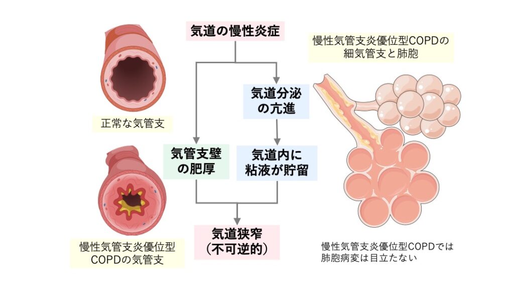 慢性気管支炎優位型COPDの病態を示した図。気道の慢性炎症を背景に、気道分泌の亢進による粘液貯留と、気管支壁の肥厚が並行して進行し、不可逆的な気道狭窄をきたす。正常な気管支と比較して、慢性気管支炎優位型COPDでは内腔が著しく狭小化している。一方、肺胞病変は目立たない。