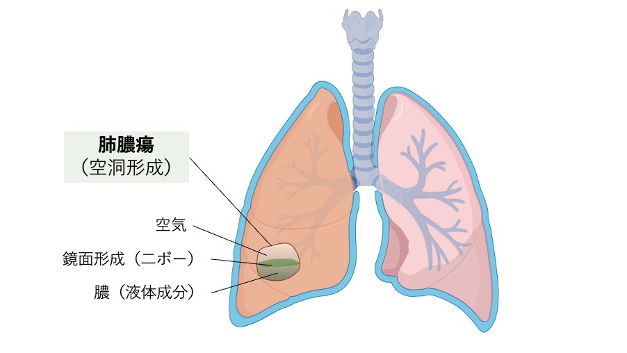 肺膿瘍の病態を示す模式図。肺実質内に空洞が形成され、内部に膿と空気が貯留することで鏡面形成（ニボー）を呈する様子を示している。