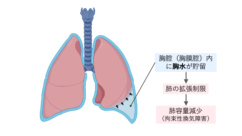 胸腔内に胸水が貯留することで肺の拡張が制限され、肺容量が減少し、拘束性換気障害が生じる過程を示した模式図。