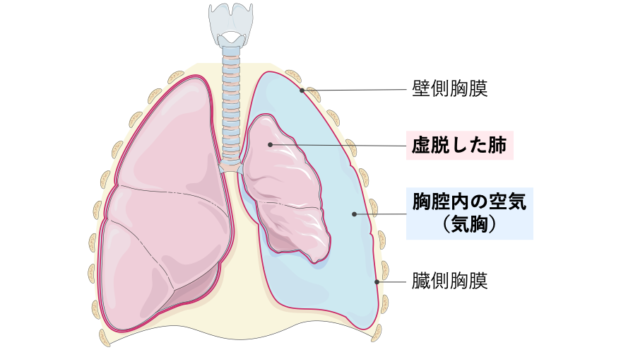 気胸の概念図。胸腔内に空気が貯留することで陰圧が失われ、臓側胸膜に覆われた肺が虚脱している状態を示す。壁側胸膜と臓側胸膜の位置関係、および胸腔内の空気(気胸)が分かる。
