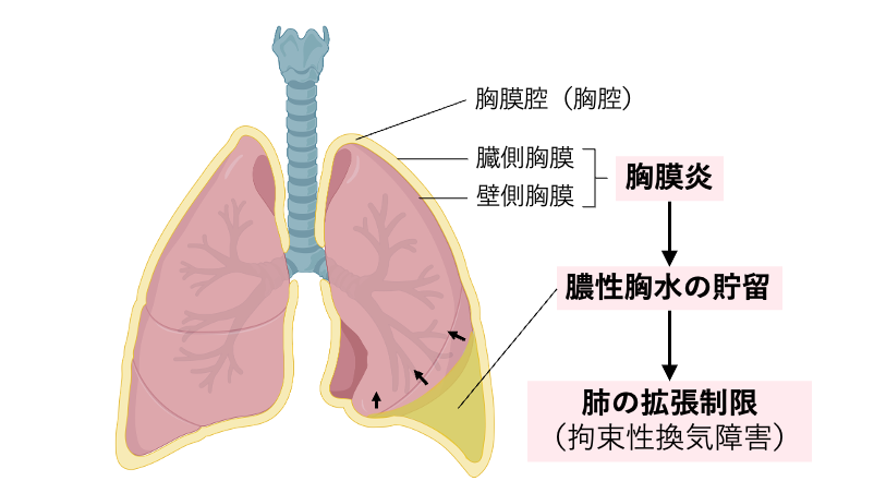 膿胸の病態を示す模式図。胸膜炎により胸膜腔（胸腔内）に膿性胸水が貯留し、肺が外側から圧排されて拡張が制限される様子を示している。