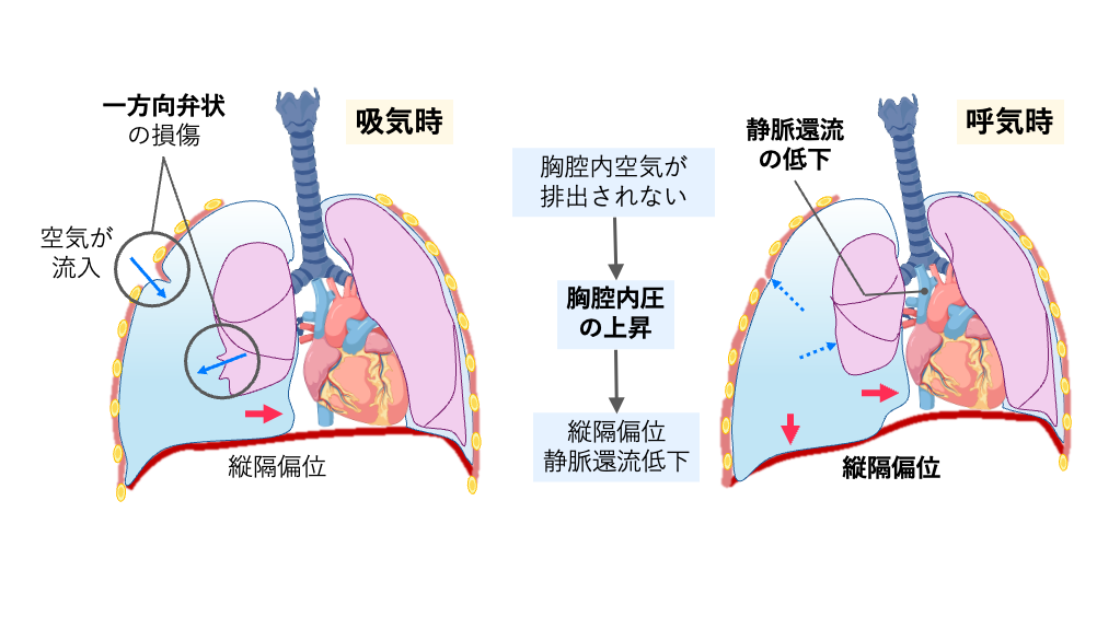緊張性気胸の模式図。吸気時に胸腔内へ空気が流入し、呼気時に排出されないことで胸腔内圧が上昇し、縦隔偏位と静脈還流低下を生じる様子を示す。