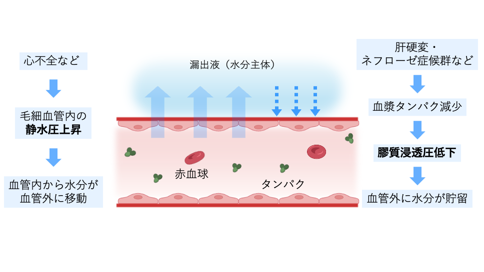 心不全による毛細血管内静水圧の上昇や、肝硬変・ネフローゼ症候群による血漿タンパク減少に伴う膠質浸透圧低下によって、血管構造は保たれたまま血管内の水分が血管外へ移動し、漏出性胸水が生じる過程を示した模式図。