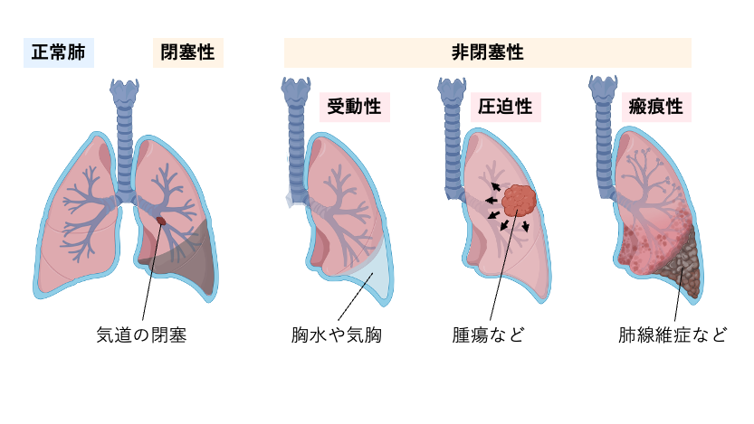 無気肺の分類を示した模式図。正常肺と比較し、気道閉塞による閉塞性無気肺、気胸や胸水による受動性無気肺、腫瘍などによる圧迫性無気肺、肺線維症による瘢痕性無気肺の病態の違いを示している。