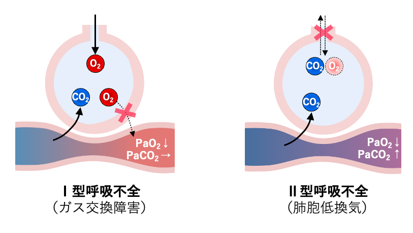 Ⅰ型呼吸不全とⅡ型呼吸不全の模式図。Ⅰ型では肺胞でのガス交換障害によりPaO₂が低下しPaCO₂は正常域を示す。Ⅱ型では肺胞低換気によりPaO₂低下とPaCO₂上昇がみられる。