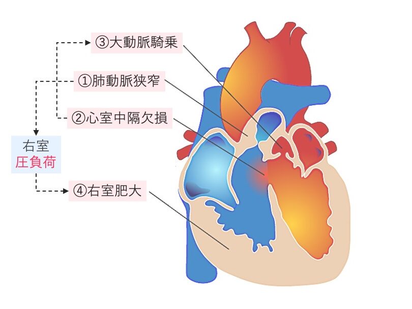 ファロー四徴症の模式図。肺動脈狭窄、心室中隔欠損、大動脈騎乗により右室に圧負荷がかかり、右室肥大を生じる病態を示す。