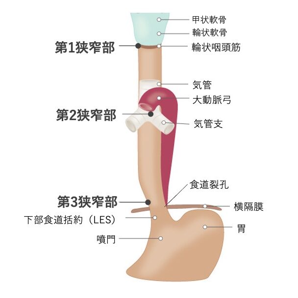 食道の3つの生理的狭窄部を示した図。第1狭窄部は食道入口部、第2狭窄部は大動脈弓と左主気管支の交叉部、第3狭窄部は横隔膜の食道裂孔部に位置する。