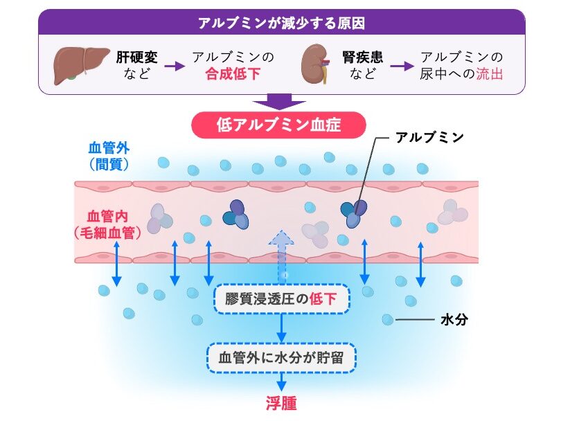 肝硬変などによるアルブミン合成低下や、腎疾患などによる尿中へのアルブミン流出によって低アルブミン血症となり、血漿膠質浸透圧が低下して血管外に水分が貯留し、浮腫を生じるしくみを示した図。